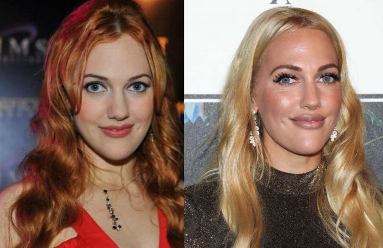 Celebrities After Failed Plastic Surgery