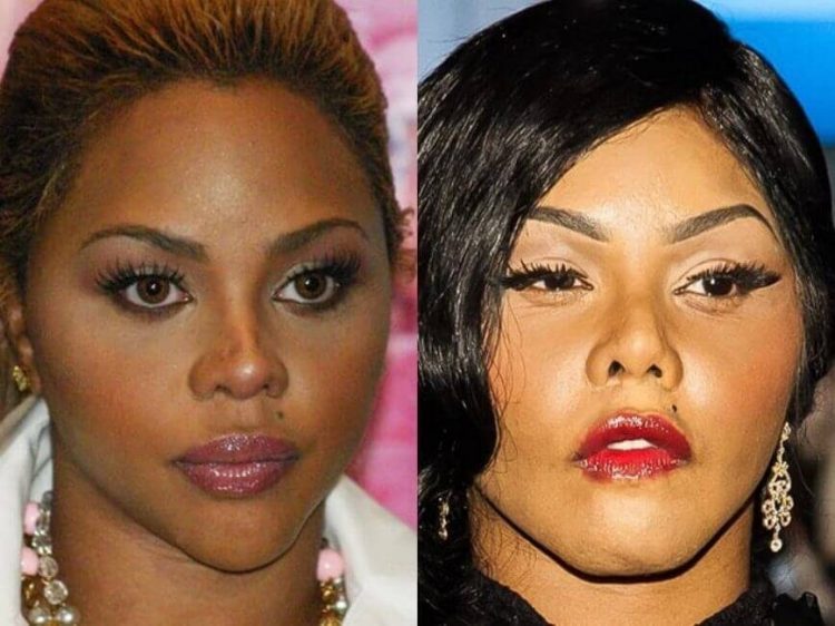 Celebrities After Failed Plastic Surgery