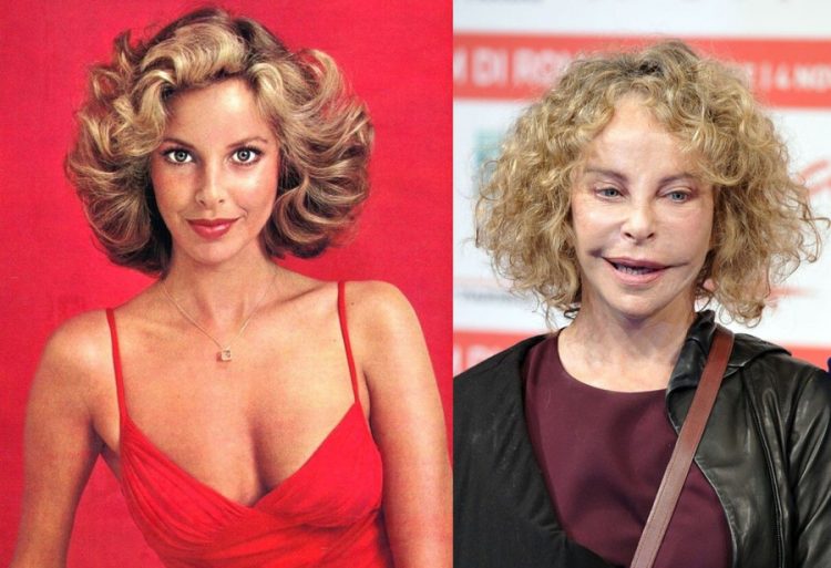 Celebrities After Failed Plastic Surgery