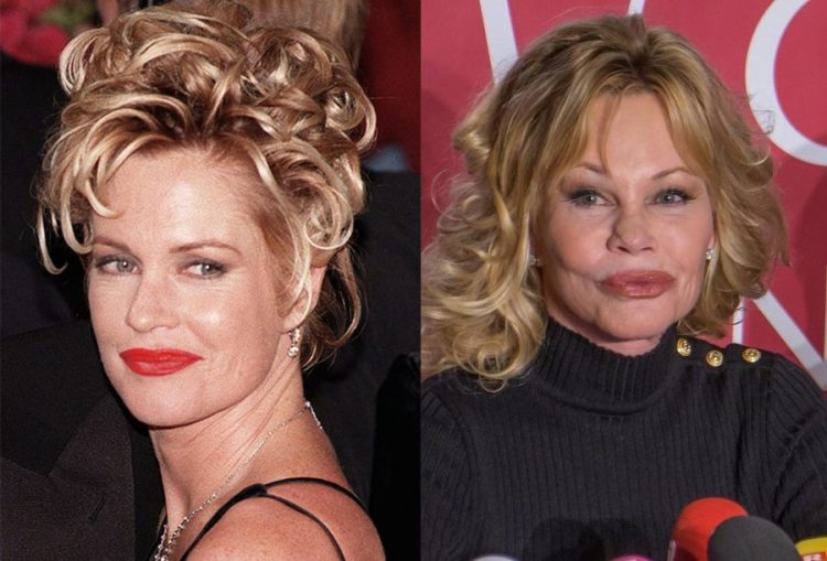 Celebrities After Failed Plastic Surgery