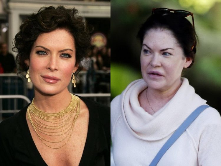 Celebrities After Failed Plastic Surgery