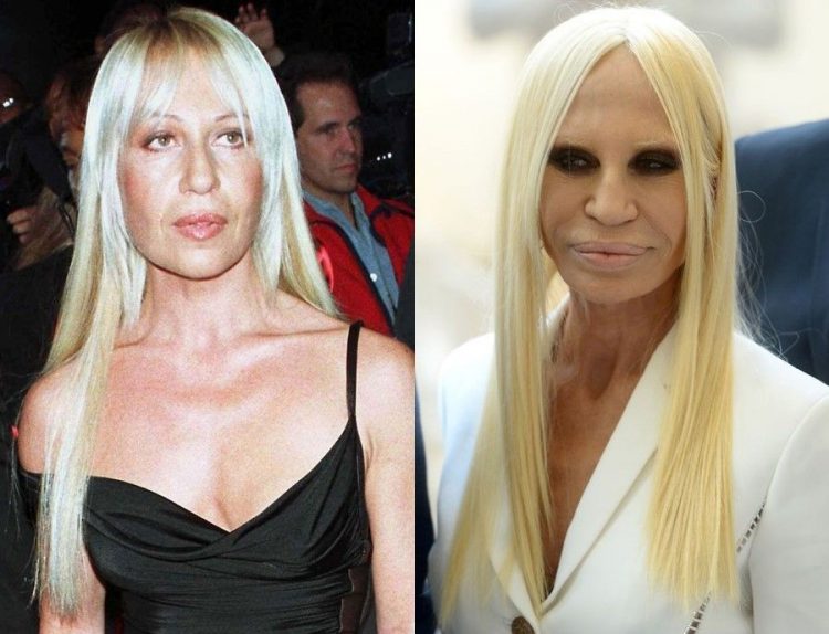 Celebrities After Failed Plastic Surgery